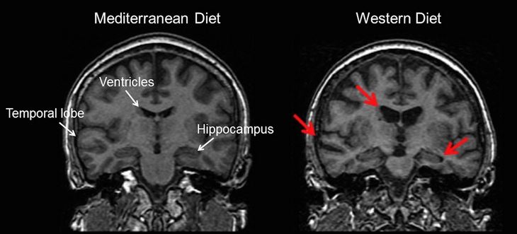 Slika 2: Primerjava možganov pri različnih dietah. Rdeče puščice kažejo atrofije, ki nastanejo zaradi nezdrave prehrane