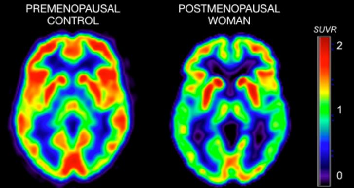 Slika 1: PET sken na levi kaže možgansko aktivnost (npr. metabolizem) pri ženskah pred menopavzo; sken na desni prikazuje možgansko aktivnost pri ženski po menopavzi